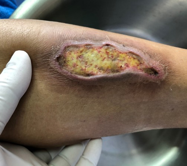 Infected wounds