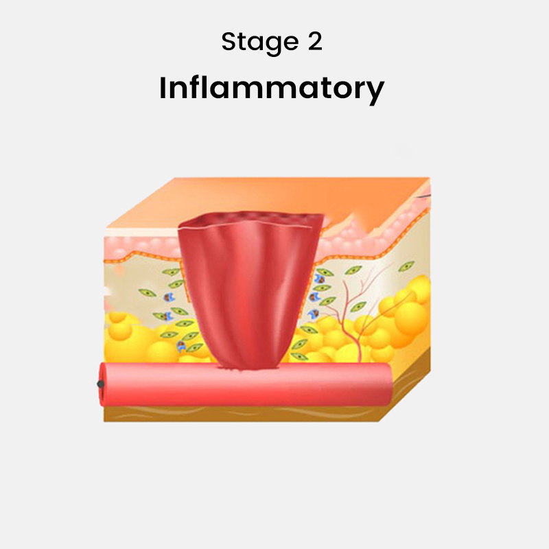Inflammatory
